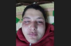 طفل أصيب بغاز الفلفل.jpeg
