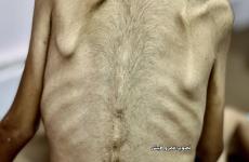 المجاعة - سوء التغذية 4.jpg