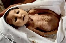 مجاعة - سوء التغذية