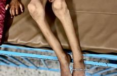 المجاعة - سوء التغذية 5.jpg