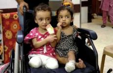 بتر أطراف بعد إصابة بقصف الاحتلال على غزة.jpg