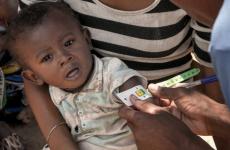 طفل يعاني من سوء تغذية.JPG