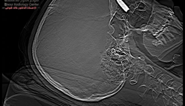 نجاح عملية جراحية معقدة في مصر لجريحة من غزة...jpg