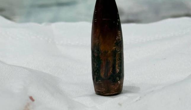 نجاح عملية جراحية معقدة في مصر لجريحة من غزة (3).jpg