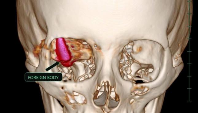 نجاح عملية جراحية معقدة في مصر لجريحة من غزة (4).jpg