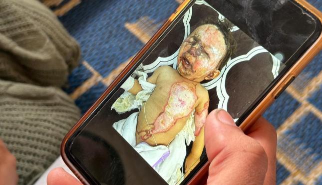 الطفل حجيلة حرق.jpg