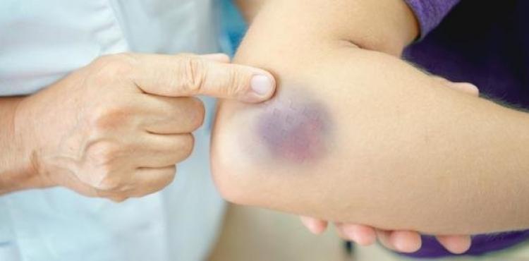 البقع الزرقاء على الجسم.jpeg