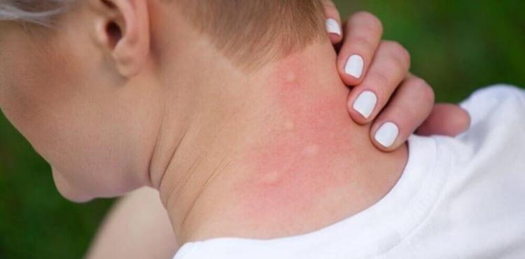 لدغة بعوض.jpg