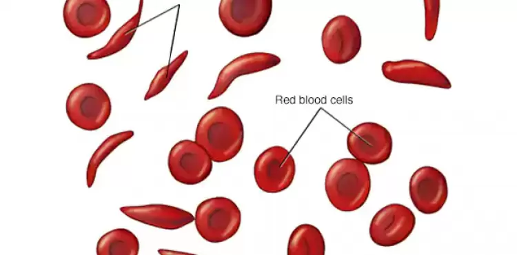 ds00324_im01729_r7_sicklecellsthu_jpg.webp