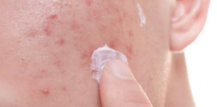 حب الشباب.jpg