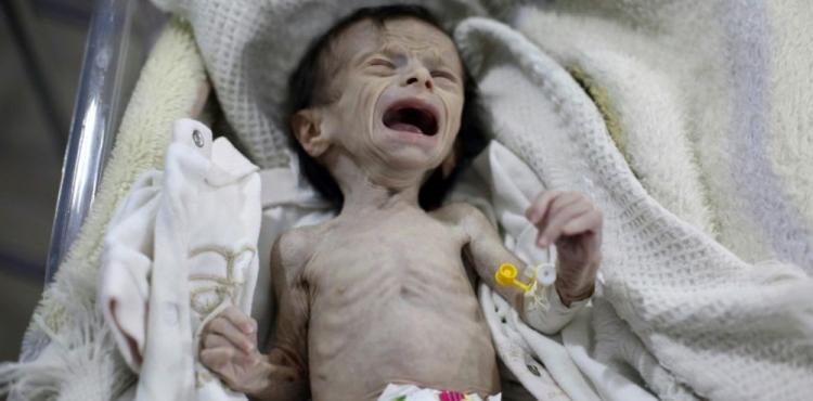 سوء التغذية أطفال غزة