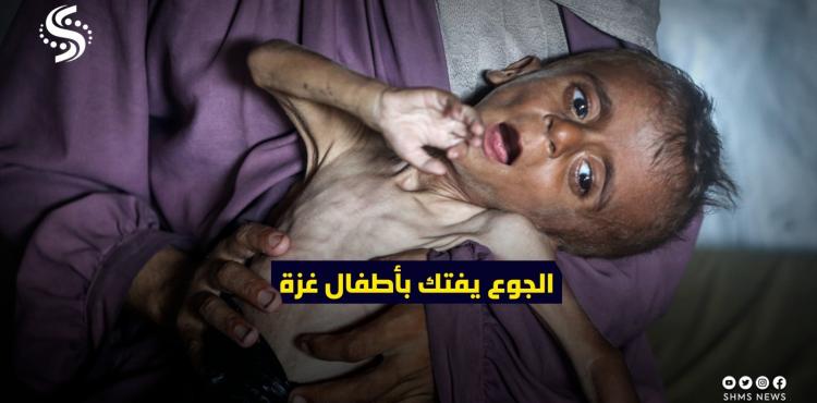 الجوع سوء تغذية التجويع أطفال غزة