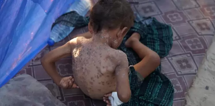 التهابات فيروسية أطفال طفح جلدي.webp