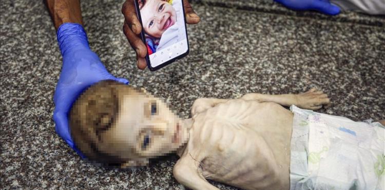 مجاعة - سوء تغذية - تجويع.jpg