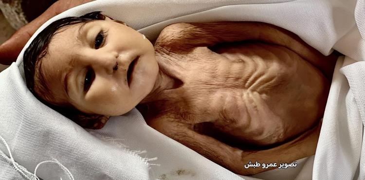 مجاعة - سوء التغذية.jpg