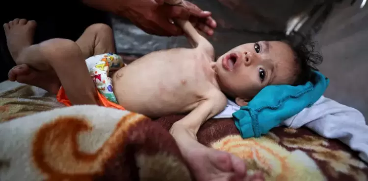 أطفال سوء التغذية.webp