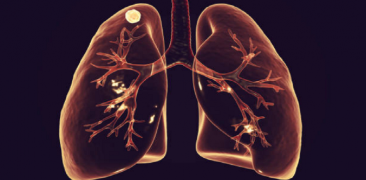 سرطان الرئة