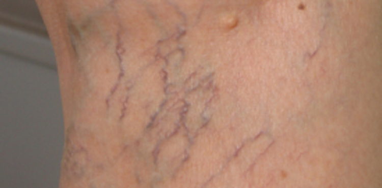 دوالي الساقين