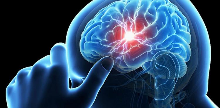 سكتة دماغية
