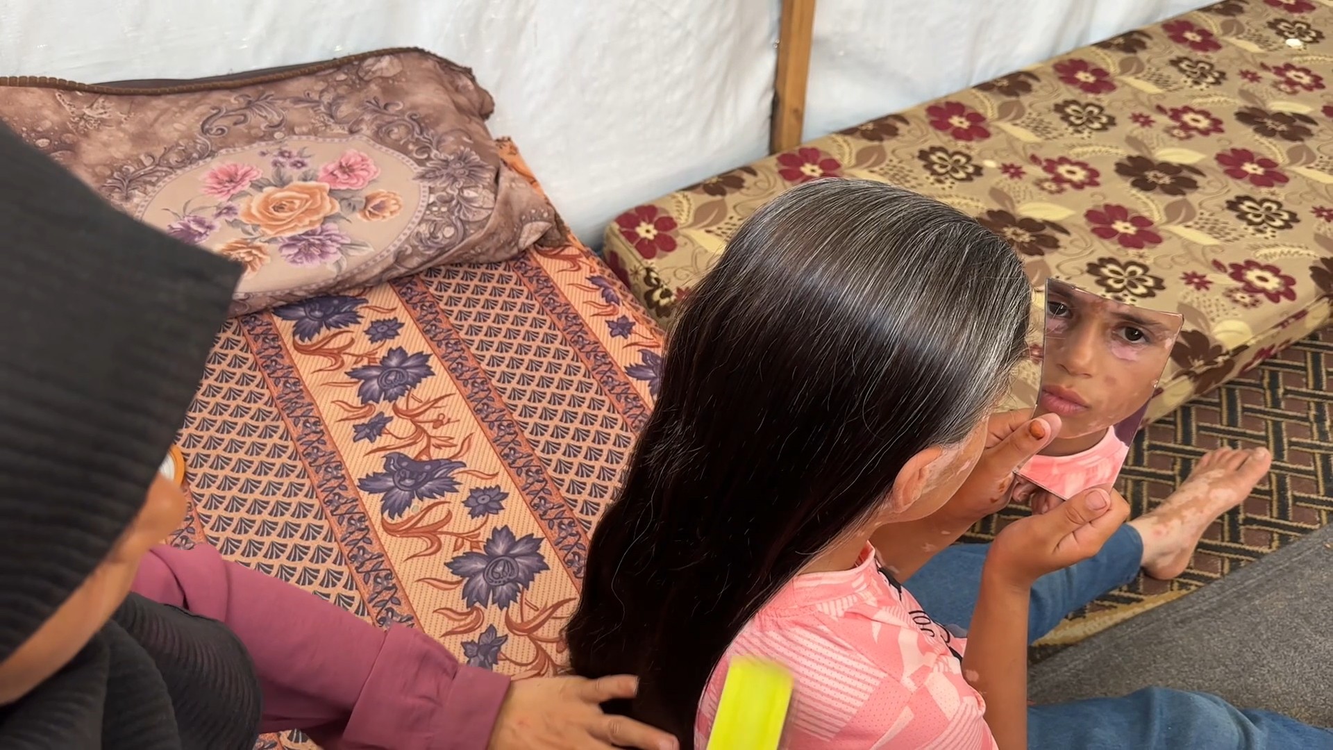 الطفلة لانا الشريف تعاني من مرض جلدي نادر بسبب الخوف من الحرب (1).jpg