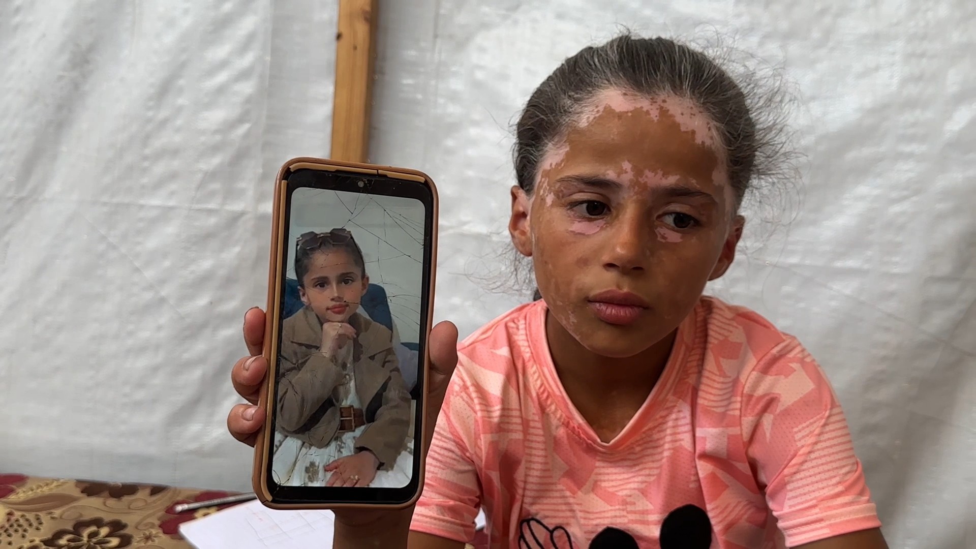 الطفلة لانا الشريف تعاني من مرض جلدي نادر بسبب الخوف من الحرب (2).jpg